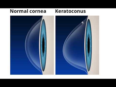 Video: Keratoconus - Symptomer, Behandling Med Folkemedicin