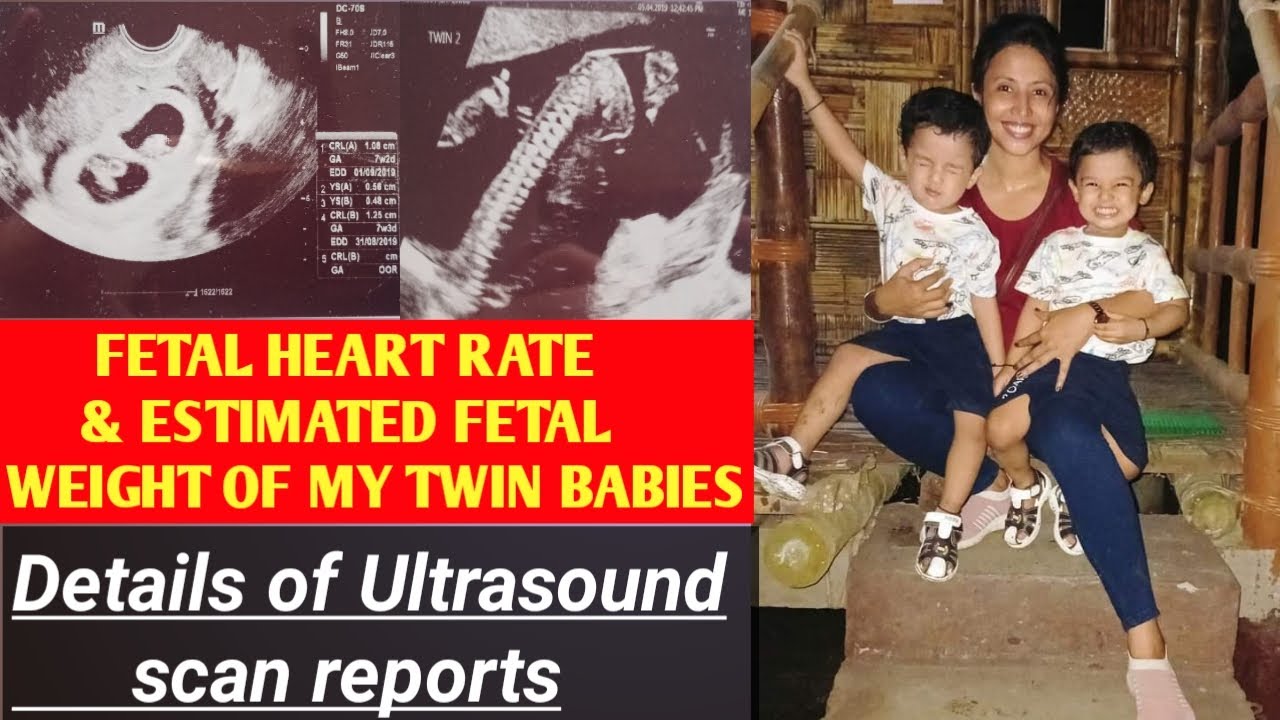 FETAL HEART RATE AND FETAL WEIGHT ESTIMATION OF MY TWINS|SCAN REPORTS