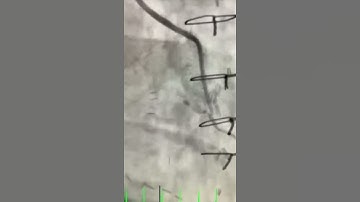 Coronary Artery Bypass Surgery Imaging