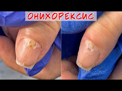 Онихорексис причины и лечение /  Трещина на ногте