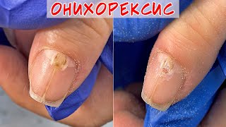 Онихорексис причины и лечение /  Трещина на ногте