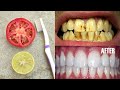 गंदे पीले दांतो को बस 5 मिनट में दूध जैसा सफेद मोती जैसा चमकदार बना देगा | teeth whitening/dant saf