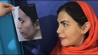 یکسال بعد از تزریق چربی به صورت | One year after facial fat injection