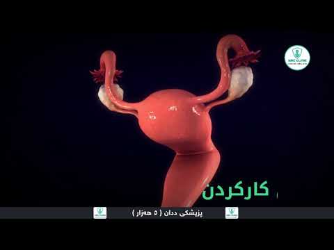 ئاماژەکانی هەوکردنی مناڵدان