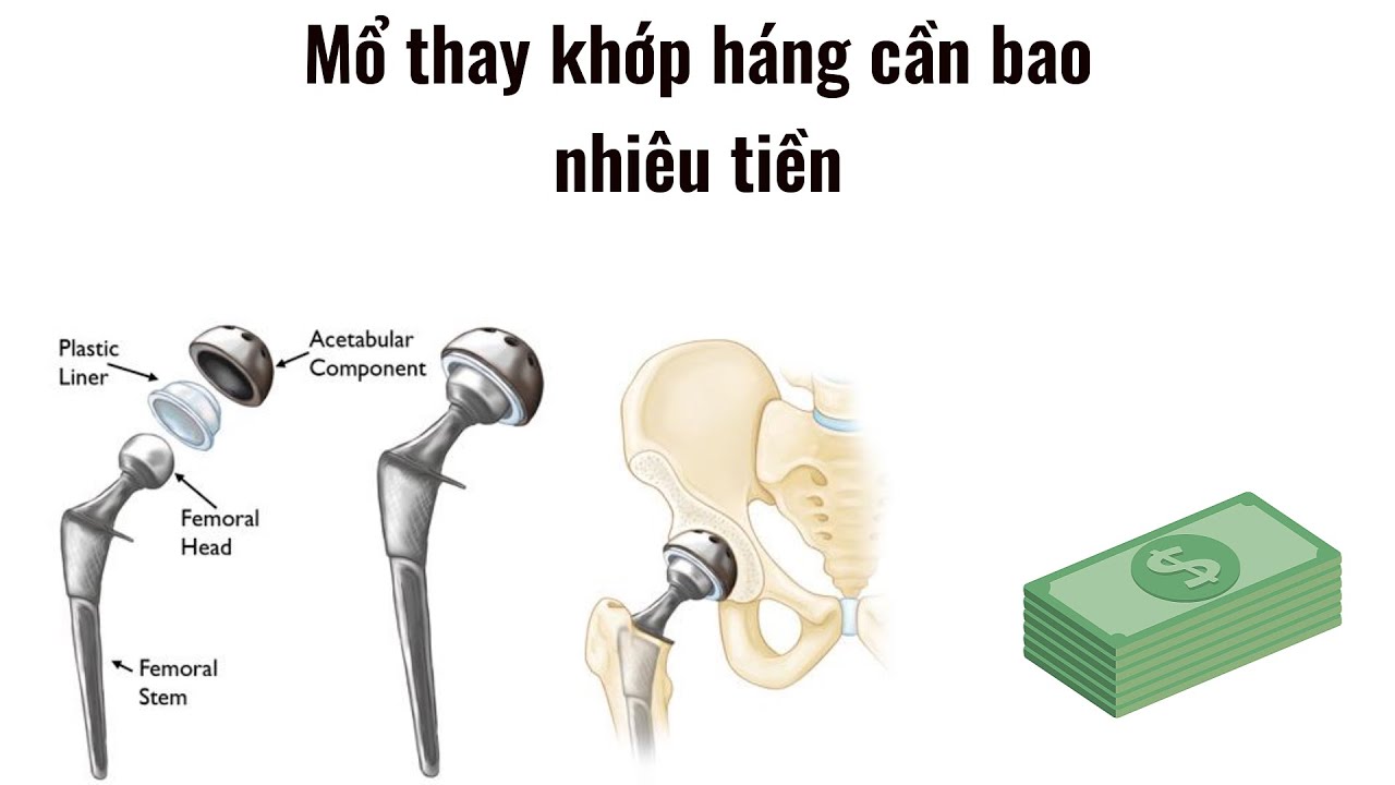 Mổ thay khớp háng điều trị hoại tử chỏm xương đùi cần bao nhiêu tiền, chi phí thực tế