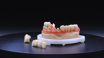 14 units monolithic zirconia | full workflow