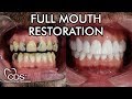 Why is Cancun Dental Specialists the Best Clinic to Get Full Mouth Restoration in Mexico?
