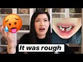 Getting BRACES as an ADULT in 2020! My HORRIBLE YET FUN Experience! PRICE? COST? PAIN? | kimcurated