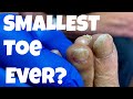 THE SMALLEST TOE IN THE WORLD 😱