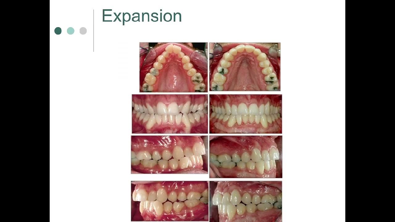 DEPARTMENT OF ORTHODONTICS METHODS OF GAINING SPACE YouTube