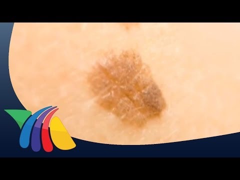 Video: ¿Todos los lunares escamosos son cancerosos?