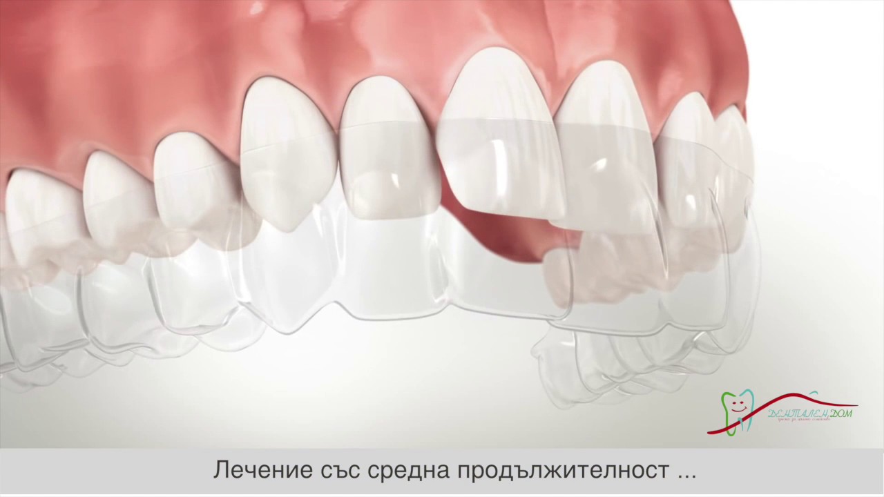 Невидими шини-Алайнери