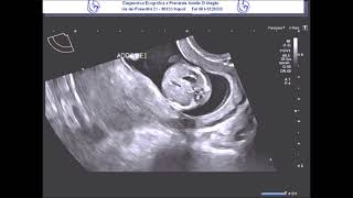 Scoliosis in the first trimester