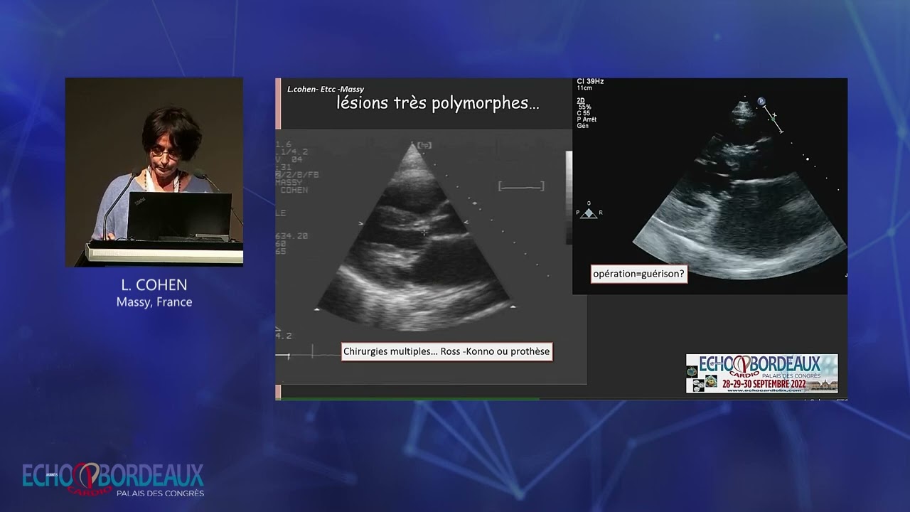 Les obstacles à l’éjection du ventricule gauche de l’adolescent