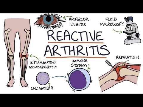 Reactive arthritis | Drk