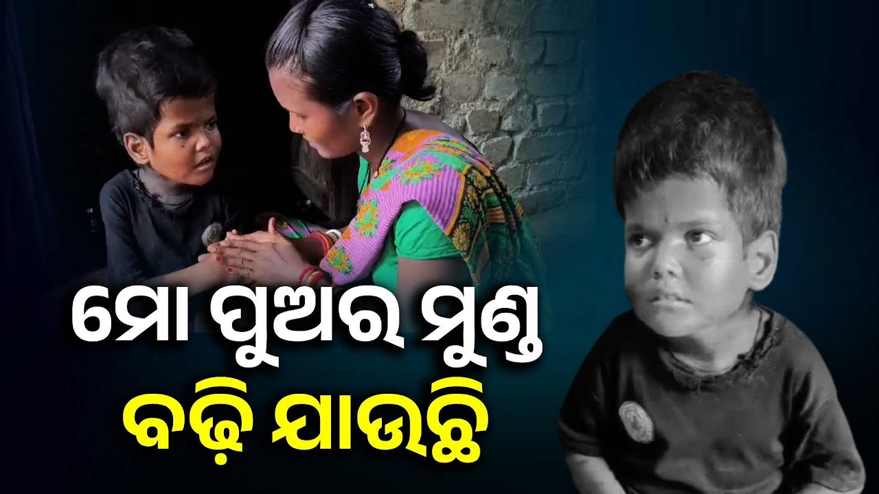 ଗରିବ ଘରେ ଦଇବ ଦେଇଛି ଦୁଃଖ, ଦିବ୍ୟାଙ୍ଗ ପିଲାଟିର ମୁଣ୍ଡ ଅସ୍ବାଭାବିକ ଭାବେ ବଡ଼ ହେଉଛି || Knews Odisha