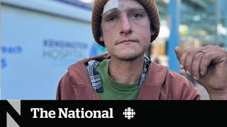 How a fleshrotting ‘zombie drug’ is complicating the overdose crisis