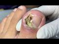 Wow, Super Thick Onychomycosis Requires Careful Trimming! #toenails  #4
