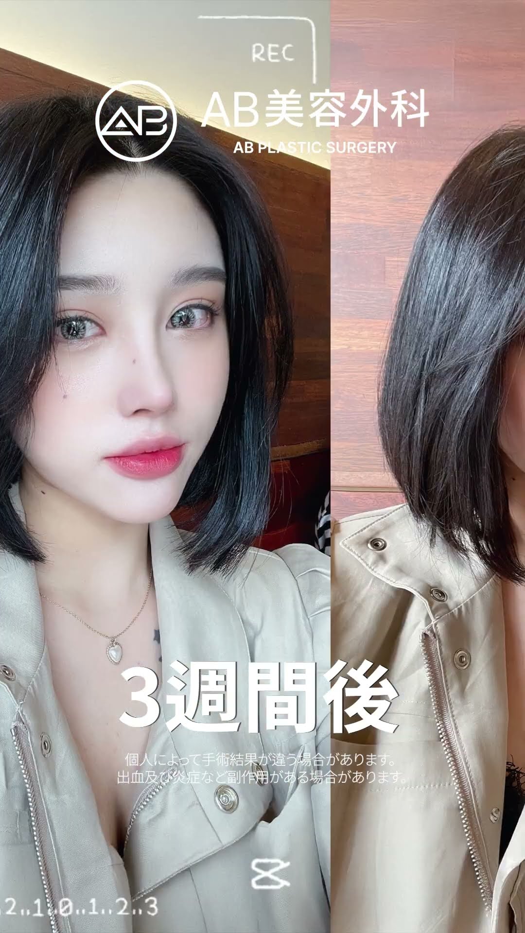 整形で完成した美の女王！ #韓国整形 #美容