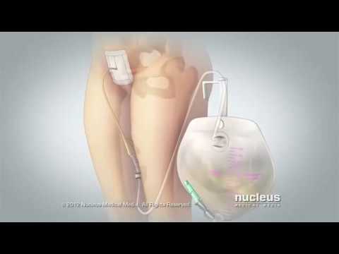 Suprapubic Catheter Care - YouTube