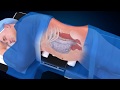 Medtronic olif25 procedure spine animation