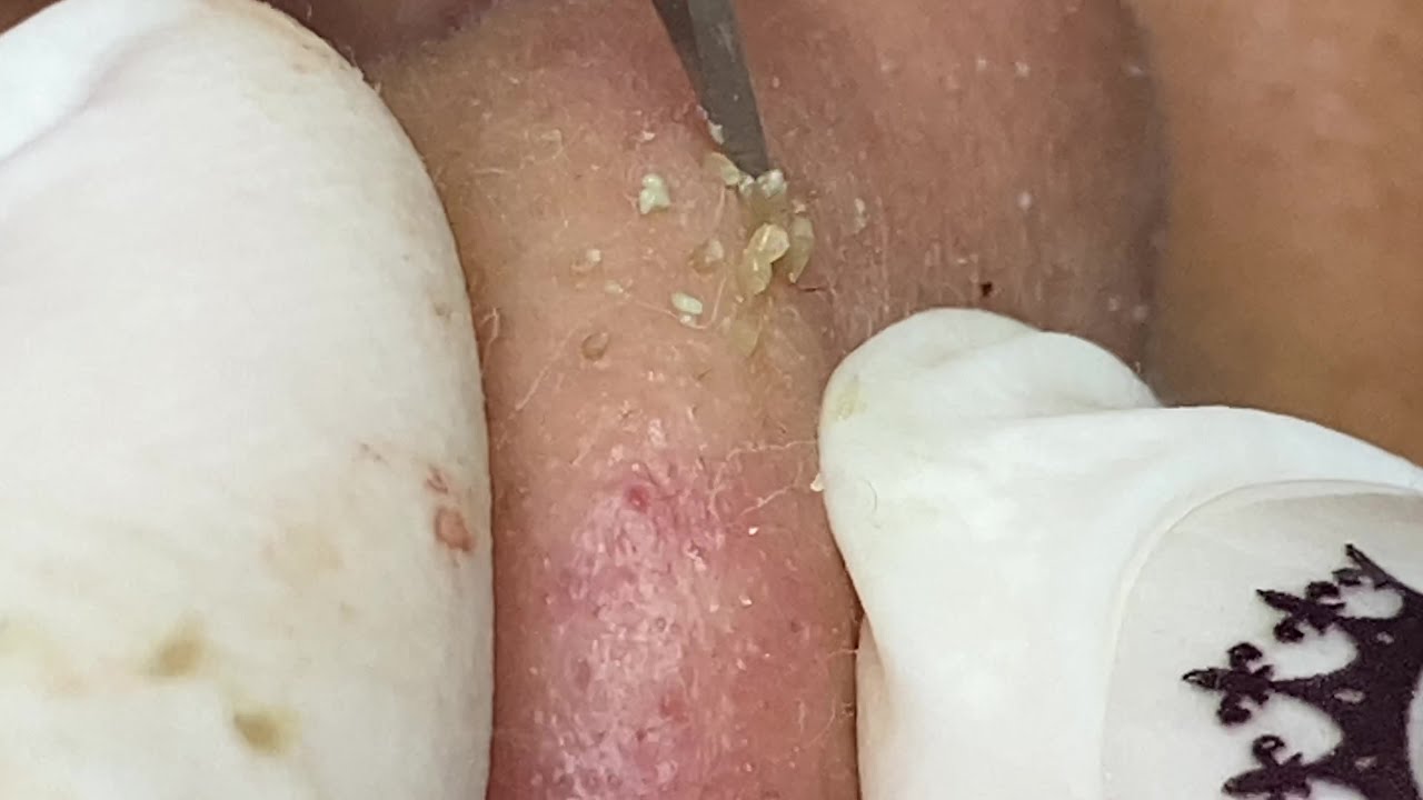 Hot Hot Hot! Removing Blackheads On Nose  | Mụn Đầu Đen Trên Mũi - SacDepSpa#101