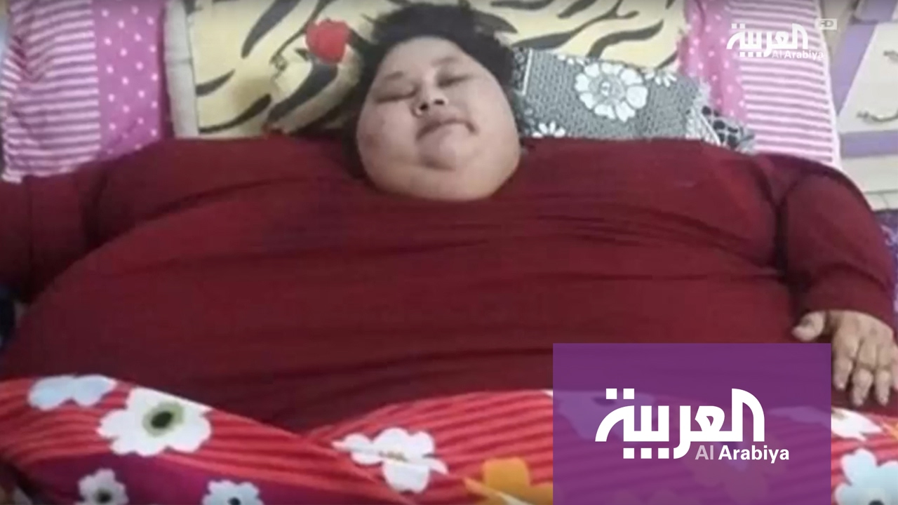 عملية جراحية لفتاة مصرية تزن نصف طن في الهند