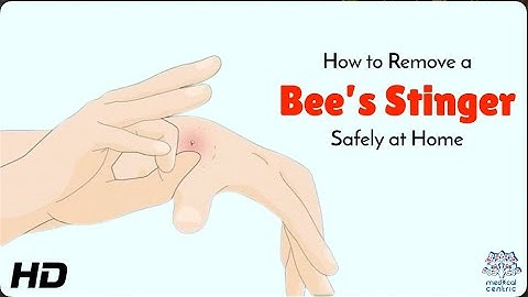 Bee Sting Emergency: What to Do First