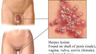 Symptome herpes genitalis Herpès génital