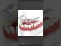 How does invisalign aligners work to straighten teeth