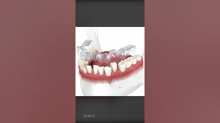 How Does Invisalign Aligners Work To Straighten Teeth