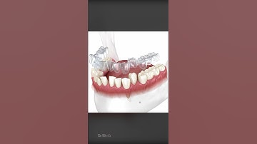 How Does Invisalign Aligners Work To Straighten Teeth