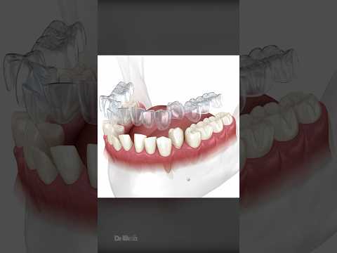 Video: Kā iztaisnot zobus ar Invisalign: 15 soļi (ar attēliem)