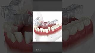 How Does Invisalign Aligners Work To Straighten Teeth screenshot 2