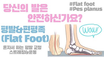 바로 효과 보는 평발(편평족) 교정 방법(Best Flat Feet Treatments)