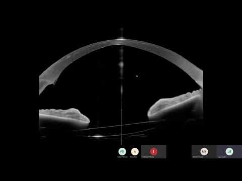 AS OCT ANTERION webinar n 1 – “Cornea and anterior segment imaging” Dr  Luca Gualdi