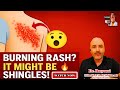 Is Shingles Contagious? What You Must Know RIGHT NOW?⚠️🔥 | ProHealthConsults