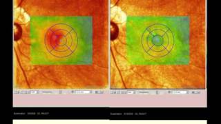 Integrating Spectral-Domain OCT into High Volume Practices