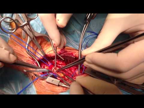 Video: Artera Carotidă - Chirurgie, Boli, Structură