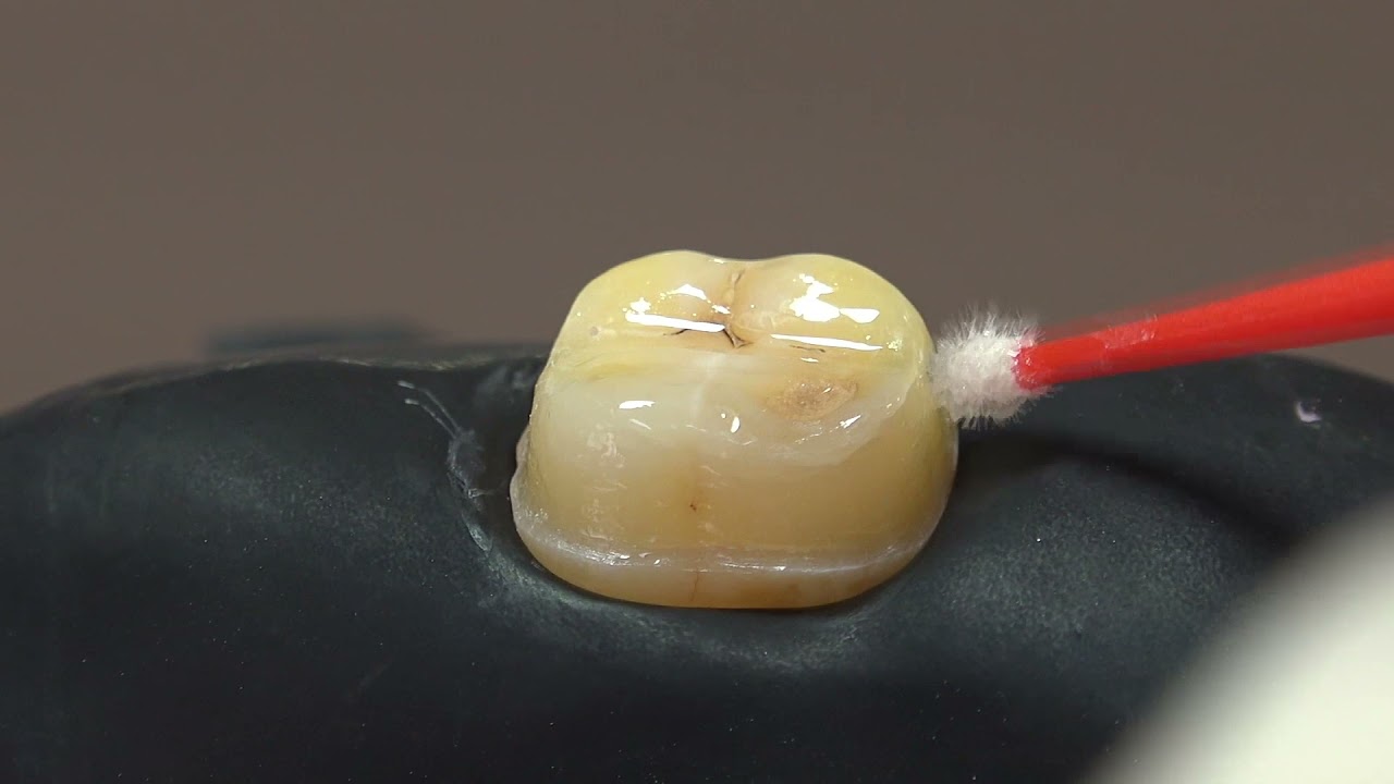 Immediate Dentin Sealing After Tooth Preparation