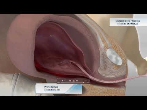 Video: Le 3 Fasi Del Parto: Dilatazione, Espulsione E Placenta