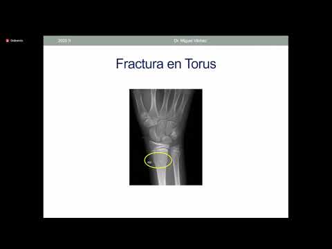 Video: En una fractura en tallo verde, ¿qué le ha ocurrido al hueso?