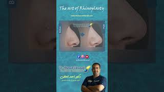 قبل و بعد عمليات تجميل الانف دكتور أحمد الحنفيbefore and after nosejob surgery for Dr Ahmed Elhanafi