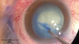 White Cataract Management