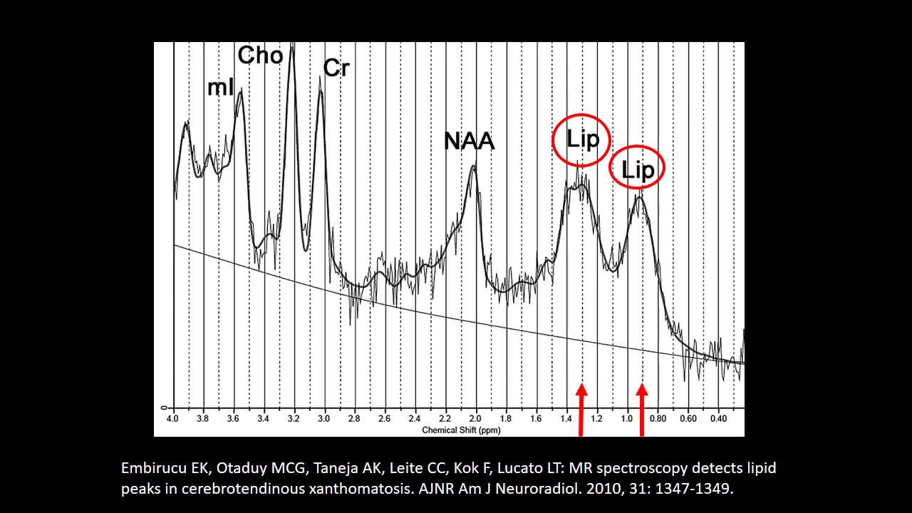 MR Spectroscopy in Neuroimaging