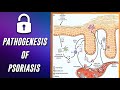 Pathogenesis of Psoriasis | Psoriasis explained | For Postgraduates | Dr.T.Vanathi