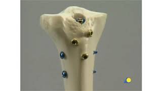 AO Tibia   Fracture   Intramedullary Nailing with the Expert Tibial Nail With Reaming