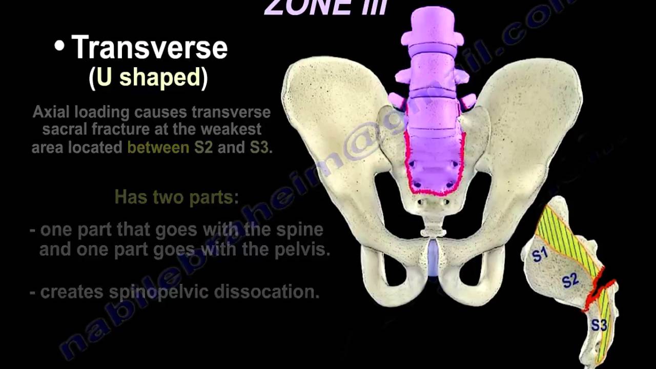 Distal Sacral Fracture