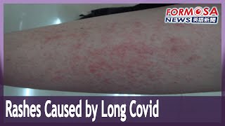 Doctors warn that long COVID symptoms can include outbreaks of rashes and pustules
