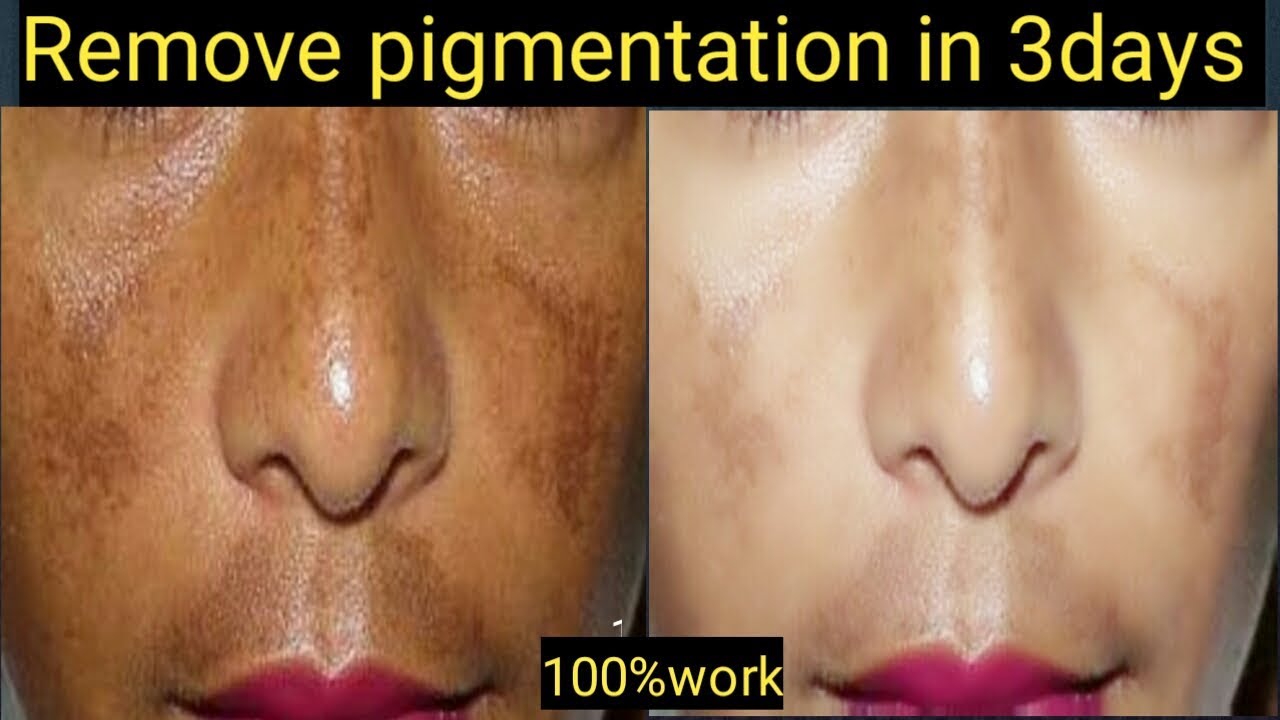 Pigmentation kaise hataye/pigmentation treatment at home/face pack for